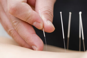 Acupuncture needles treatment